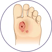 Foot with two open wounds illustration.