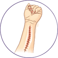 Illustration of stitched wound on forearm.