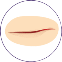 Illustration of a surgical incision scar.
