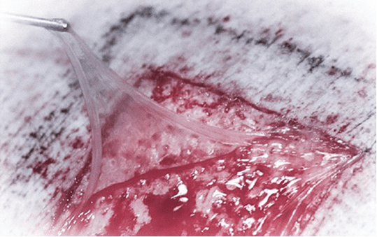 Close-up of a wound covered with dressing.