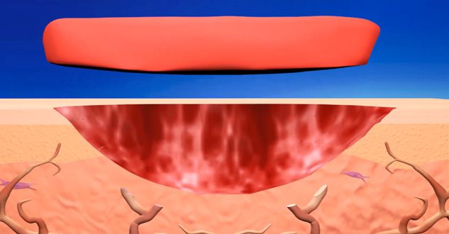 Illustration of skin healing with tissue layers.