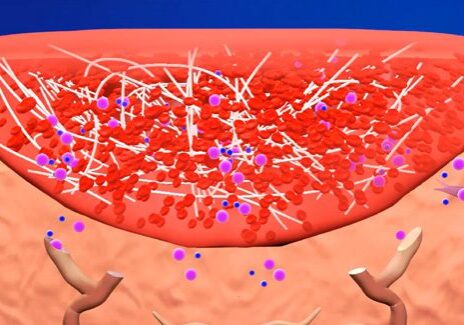 Illustration of blood clotting in a wound.